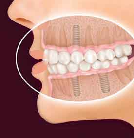 Расположение зубных протезов